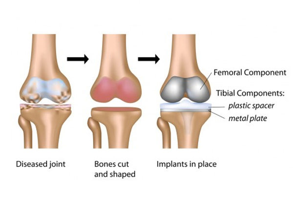 Joint Replacement