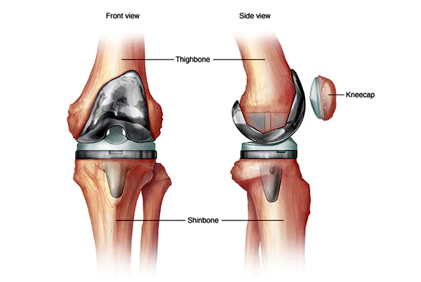 Knee Replacement