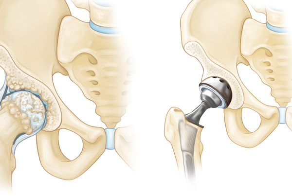 Hip Replacement