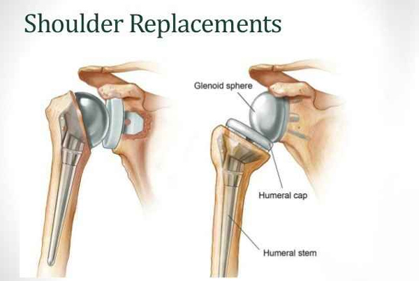 Shoulder Replacement