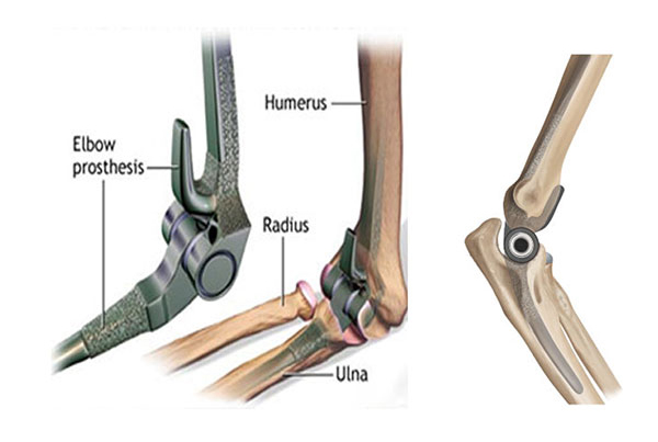 Elbow Replacement