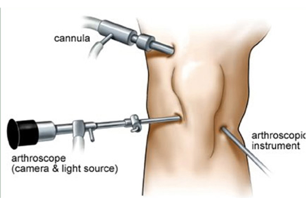 Arthroscopy